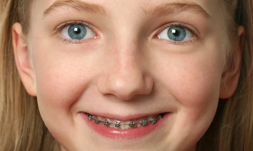 Braces For Children Arvada: The Best Orthodontist And Cost